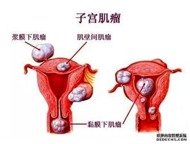 仁怀拜城县子宫肌瘤初期有哪些症状表现