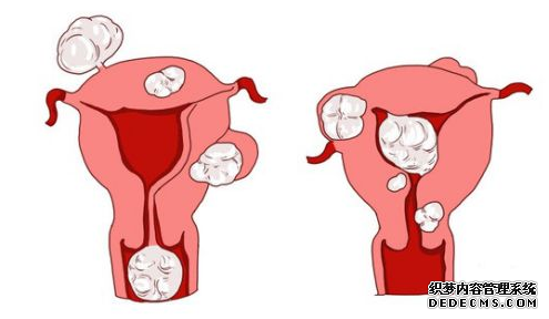 仁怀温宿县女性患有子宫肌瘤会带来哪些症状