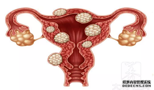 仁怀温宿县患上子宫肌瘤会有哪些症状表现
