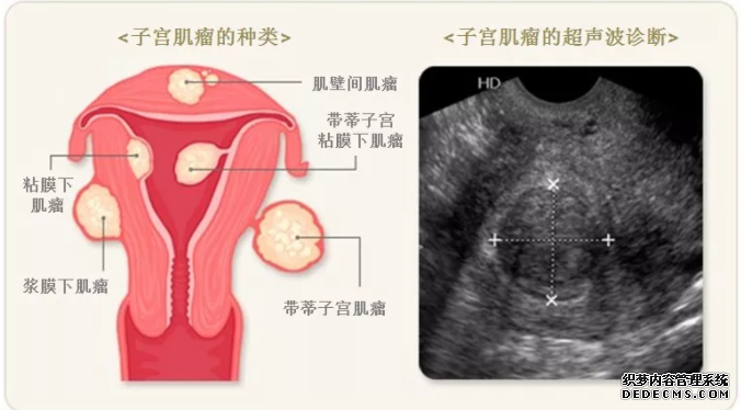 仁怀新和县女性患子宫肌瘤的原因有哪些